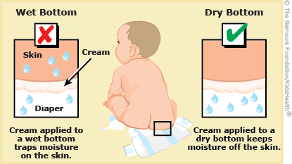 What Causes Diaper Rash in Babies