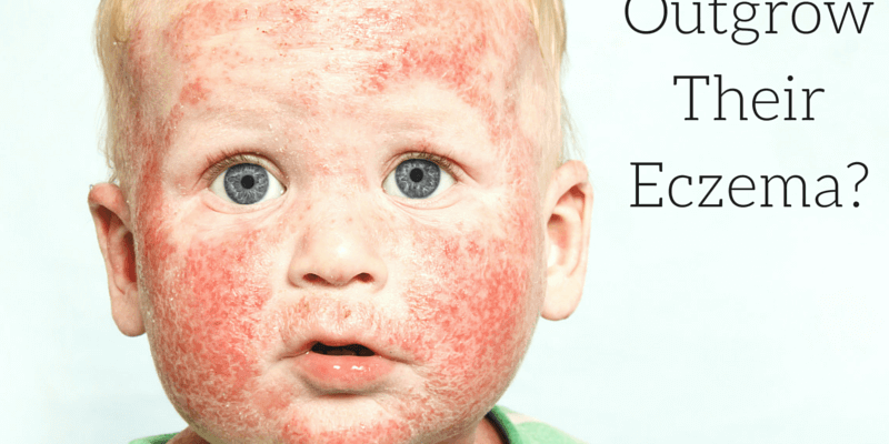 Will My Baby Outgrow Eczema